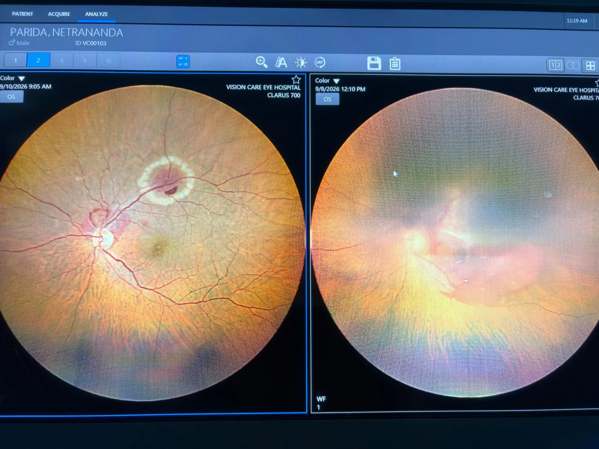 Retinal Analysis