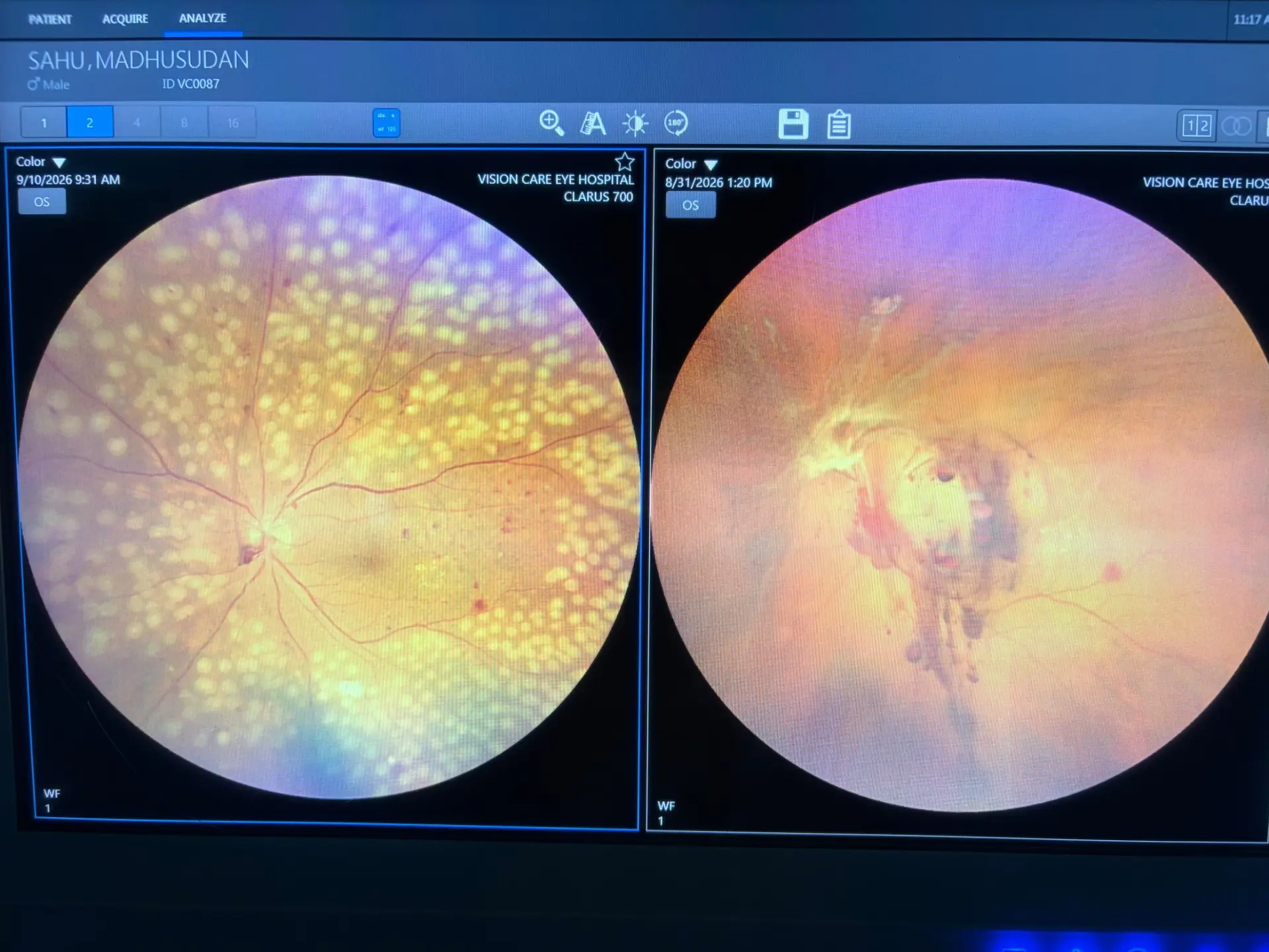 Retinal Diagnosis