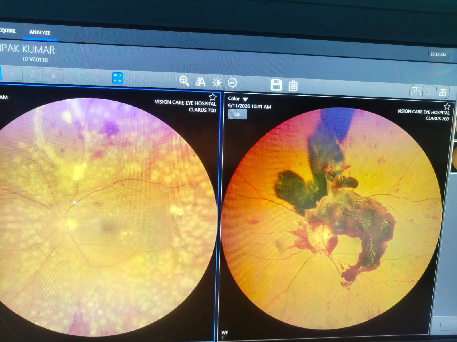 Retinal Scan