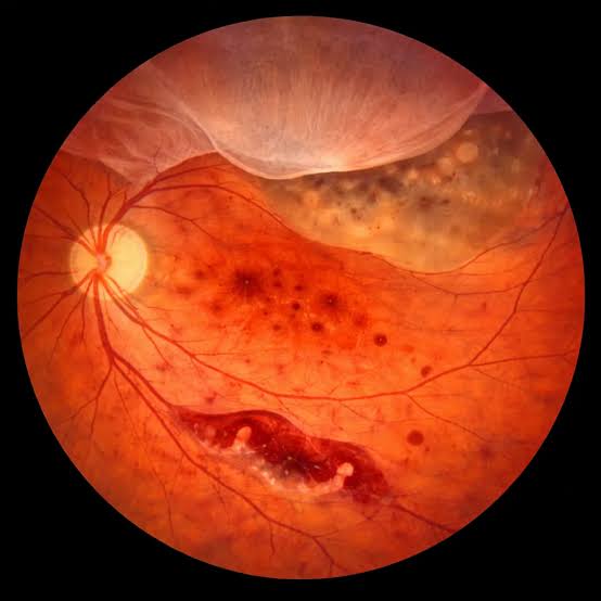 Retinal Detachment