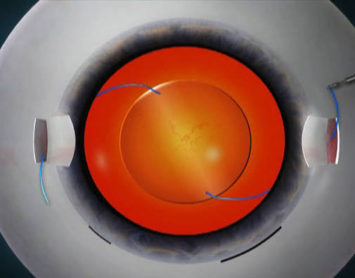 Ophthalmology care