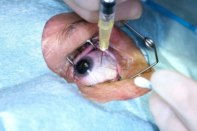 Anti-VEGF Injections