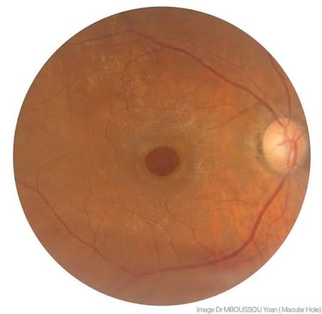 Macular Hole
