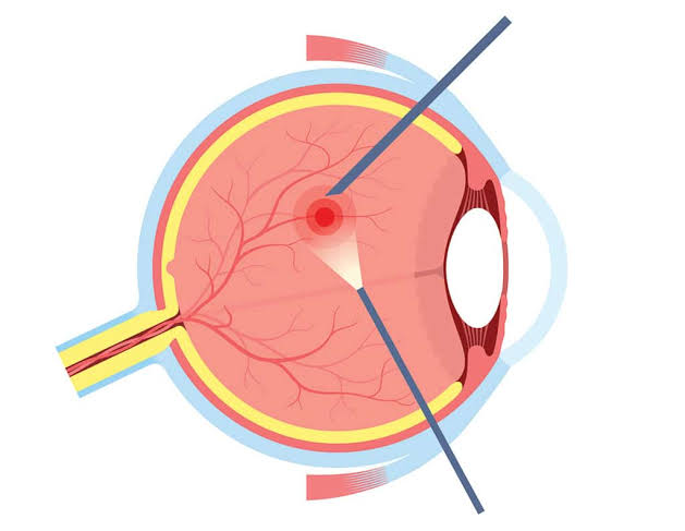 Vitreous Hemorrhage